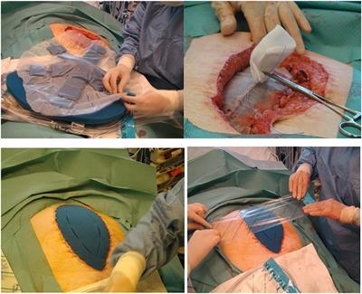 Early Initiation of a Standardized Open Abdomen Treatment With Vacuum Assisted Mesh-Mediated Fascial Traction Achieves Best Results